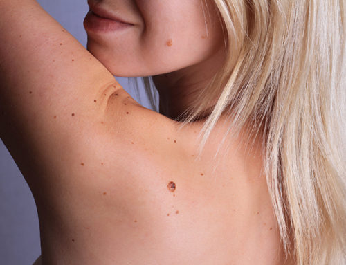 Moles: Symptoms to watch out for melanoma